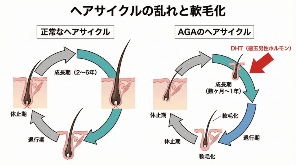 AGAのメカニズム ヘアサイクルの乱れと軟毛化の図解 成長期の短縮