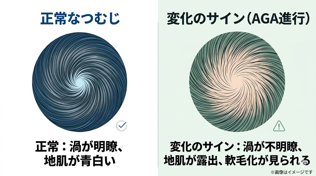 つむじの比較。左は正常なつむじ（渦が明瞭、地肌が青白い）。右はAGA進行のサイン（渦が不明瞭、地肌が露出、軟毛化が見られる）。