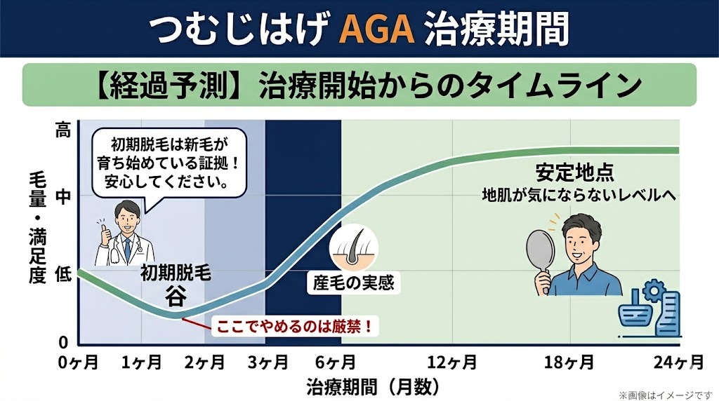 つむじはげのAGA治療開始から24ヶ月後までの経過予測グラフ。開始1〜2ヶ月目の「初期脱毛（毛量が一時的に減る時期）」、3〜6ヶ月目の「産毛の実感」、18〜24ヶ月目の「安定地点」までの流れを解説。初期脱毛は新毛が育ち始めている証拠であるという医師のアドバイス付き。