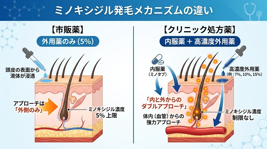 市販薬（外用薬のみ）とクリニックの処方薬（内服薬と高濃度外用薬）の発毛メカニズムの違いを示す図解