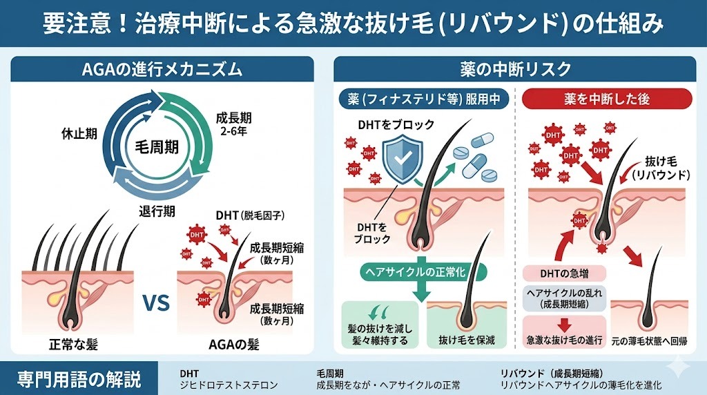 フィナステリド等のAGA治療薬中断によるDHT増加と抜け毛（リバウンド）進行のメカニズム図解