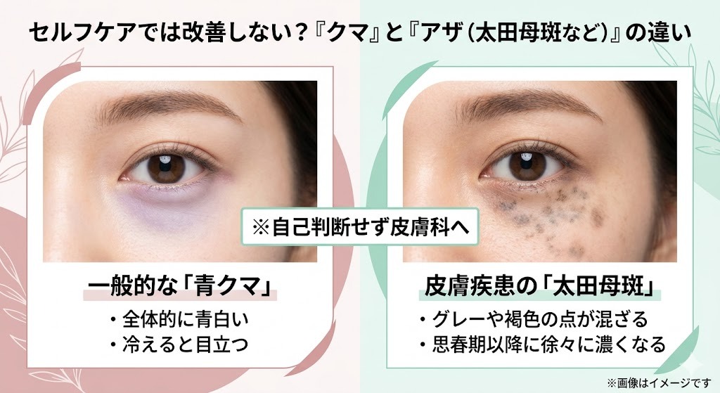 一般的な「青クマ」と、皮膚疾患である「太田母斑」の目元の比較画像。「自己判断せず皮膚科へ」という注意書き。