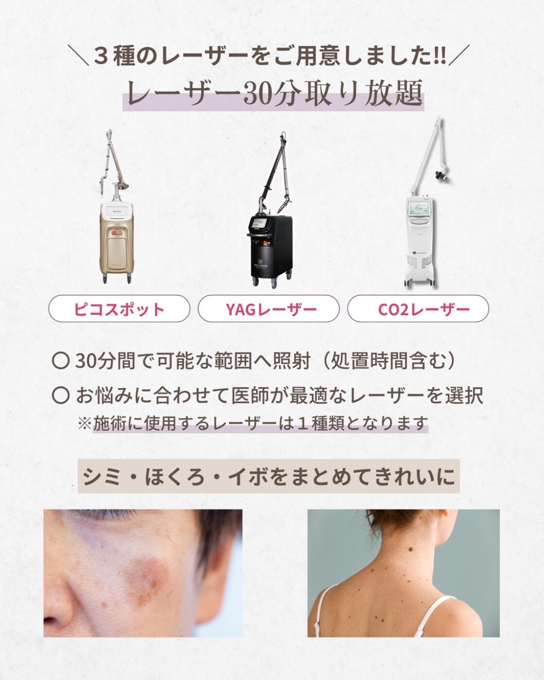 レーザー取り放題　（YAGレーザー・ピコスポット・CO2レーザー）